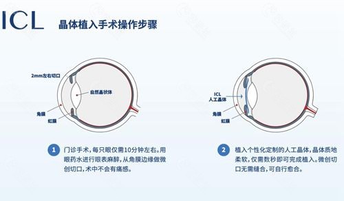 近視人工晶體植入價格詳解，費用、要點及注意事項全解析